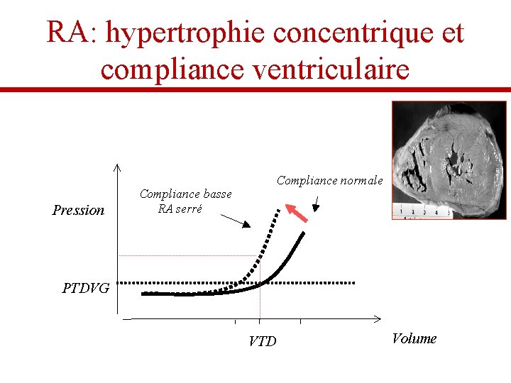 RA: hypertrophie concentrique et compliance ventriculaire Pression Compliance basse RA serré Compliance normale PTDVG