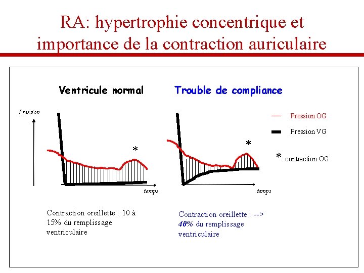 RA: hypertrophie concentrique et importance de la contraction auriculaire Ventricule normal Trouble de compliance