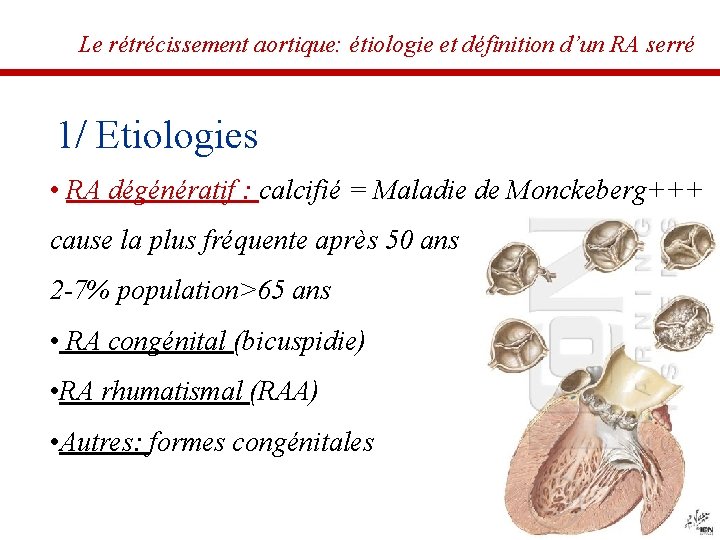 Le rétrécissement aortique: étiologie et définition d’un RA serré 1/ Etiologies • RA dégénératif