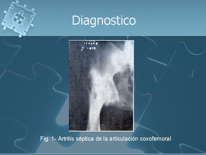 Diagnostico Fig. 1 - Artritis séptica de la articulación coxofemoral 