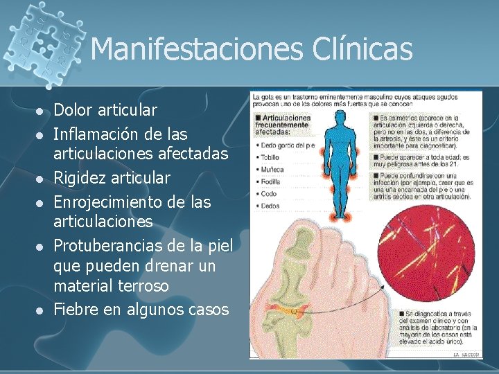 Manifestaciones Clínicas l l l Dolor articular Inflamación de las articulaciones afectadas Rigidez articular