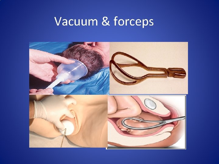 Vacuum & forceps 