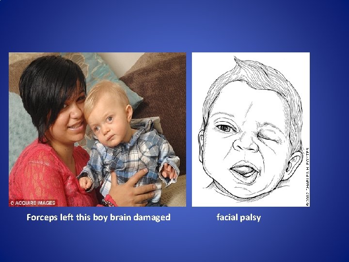 Forceps left this boy brain damaged facial palsy 