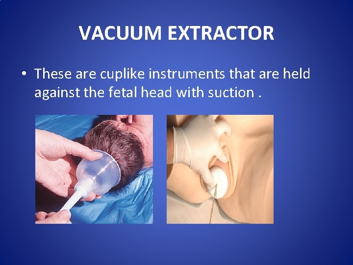 VACUUM EXTRACTOR • These are cuplike instruments that are held against the fetal head