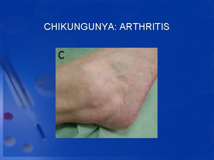 CHIKUNGUNYA: ARTHRITIS 