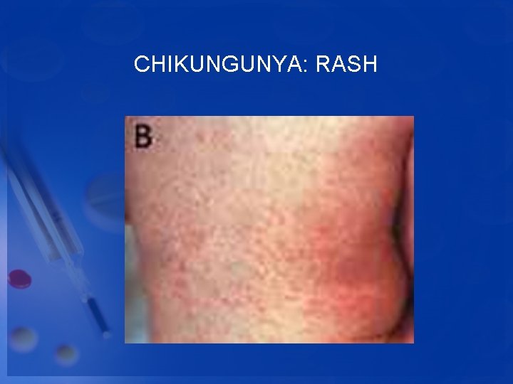 CHIKUNGUNYA: RASH 