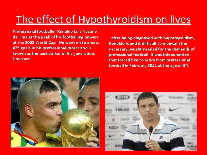 The effect of Hypothyroidism on lives Professional footballer Ronaldo Luís Nazário de Lima at