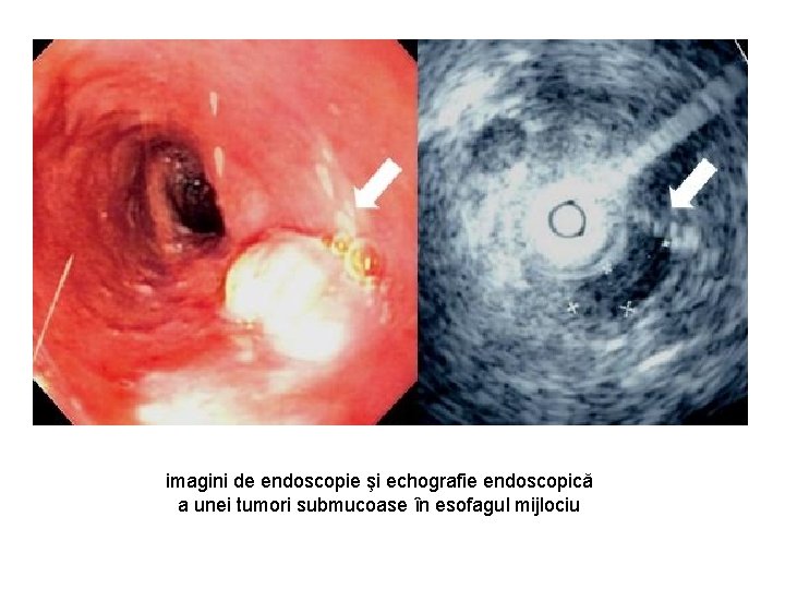 imagini de endoscopie şi echografie endoscopică a unei tumori submucoase în esofagul mijlociu 