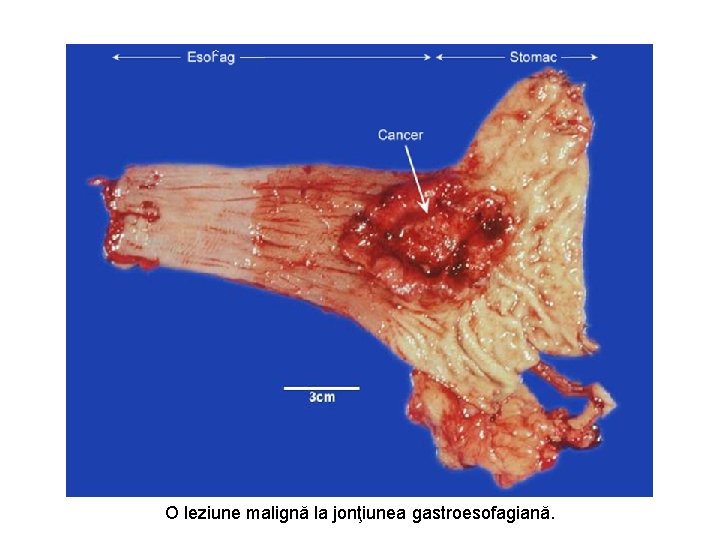 O leziune malignă la jonţiunea gastroesofagiană. 