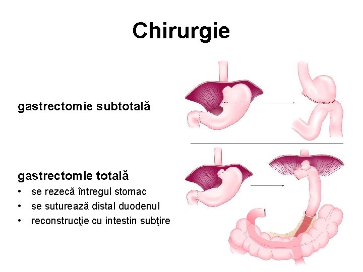 Chirurgie gastrectomie subtotală gastrectomie totală • se rezecă întregul stomac • se suturează distal