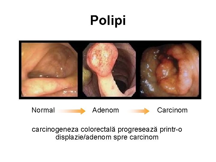 Polipi Normal Adenom Carcinom carcinogeneza colorectală progresează printr-o displazie/adenom spre carcinom 