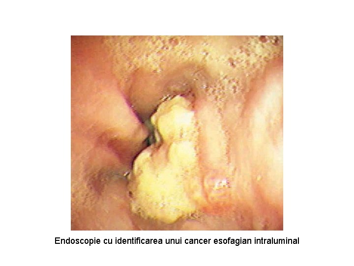 Endoscopie cu identificarea unui cancer esofagian intraluminal 