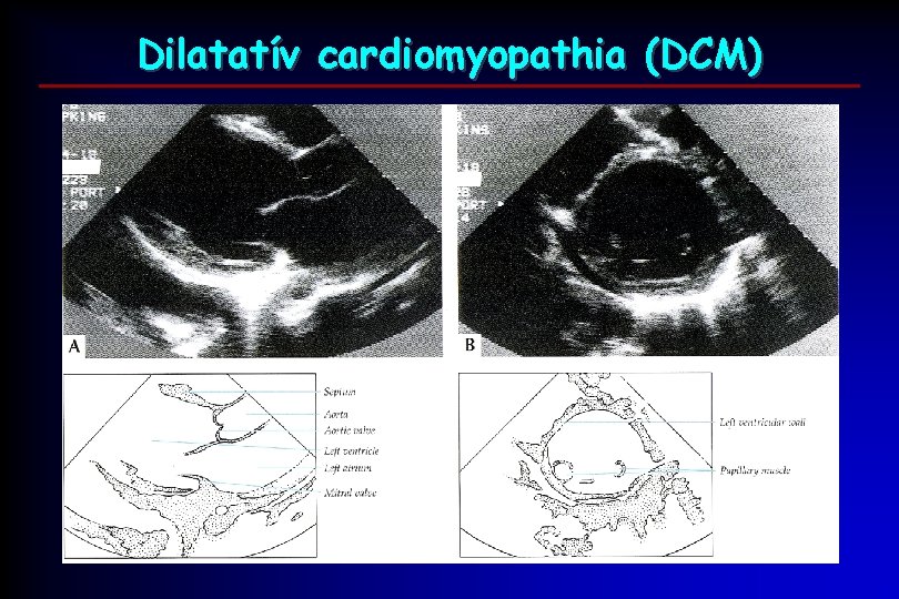 Dilatatív cardiomyopathia (DCM) 