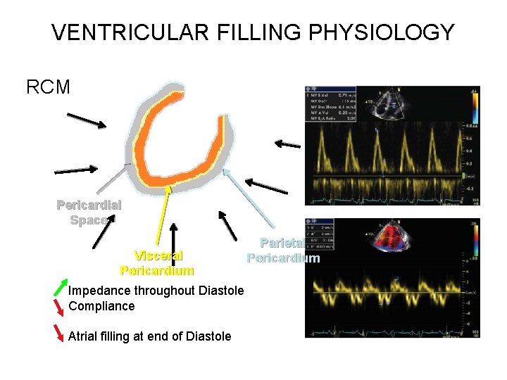 VENTRICULAR FILLING PHYSIOLOGY RCM Pericardial Space Visceral Pericardium Impedance throughout Diastole Compliance Atrial filling