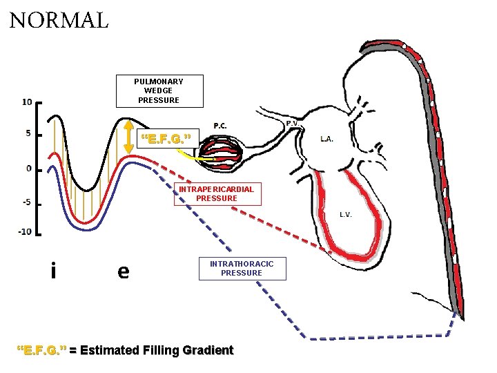 NORMAL PULMONARY WEDGE PRESSURE “E. F. G. ” INTRAPERICARDIAL PRESSURE i e INTRATHORACIC PRESSURE