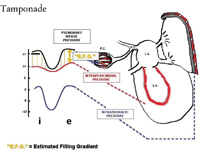 Tamponade PULMONARY WEDGE PRESSURE “E. F. G. ” INTRAPERICARDIAL PRESSURE i e “E. F.