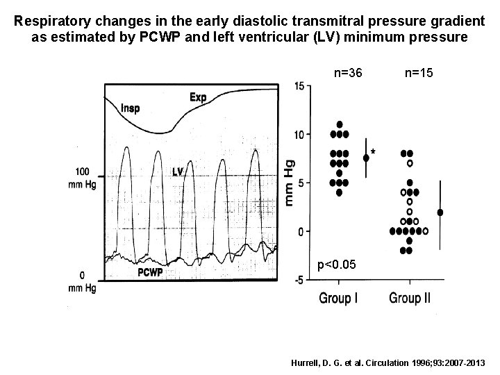 Respiratory changes in the early diastolic transmitral pressure gradient as estimated by PCWP and