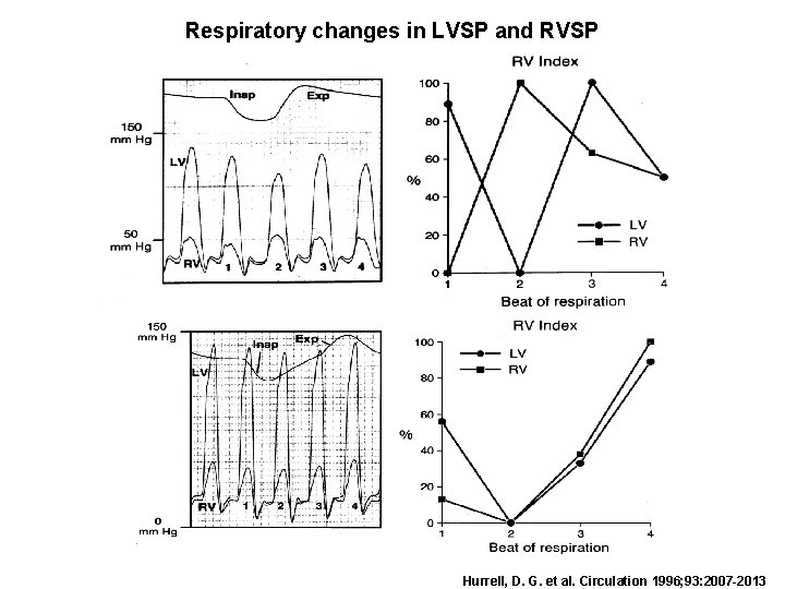Respiratory changes in LVSP and RVSP Hurrell, D. G. et al. Circulation 1996; 93: