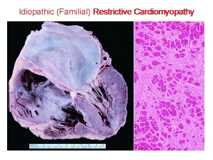 Idiopathic (Familial) Restrictive Cardiomyopathy 