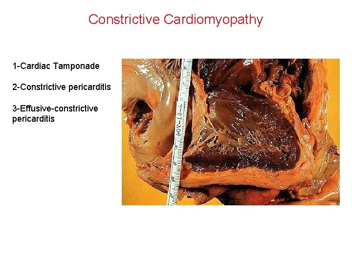 Constrictive Cardiomyopathy 1 -Cardiac Tamponade 2 -Constrictive pericarditis 3 -Effusive-constrictive pericarditis 