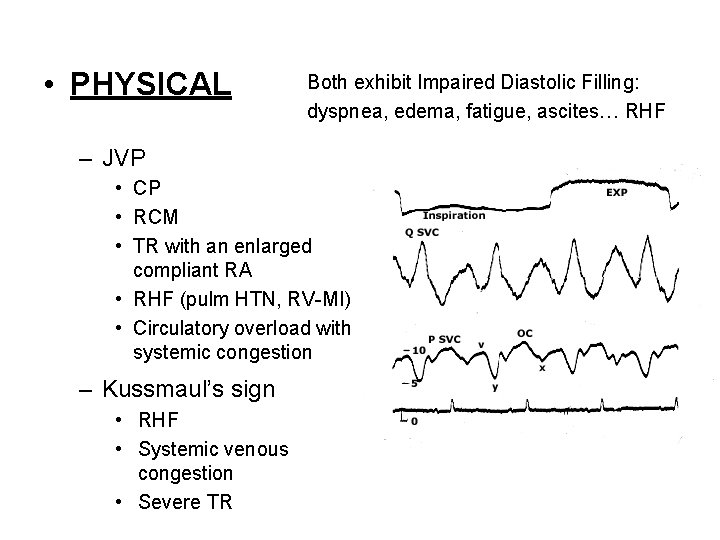  • PHYSICAL Both exhibit Impaired Diastolic Filling: dyspnea, edema, fatigue, ascites… RHF –