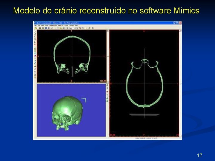 Modelo do crânio reconstruído no software Mimics 17 