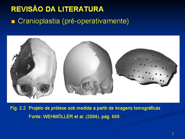 REVISÃO DA LITERATURA n Cranioplastia (pré-operativamente) Fig. 2. 2 Projeto de prótese sob medida