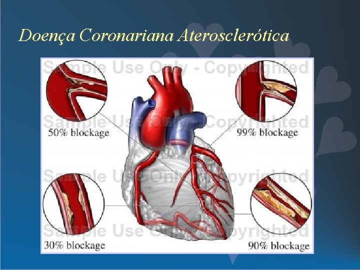 Doença Coronariana Aterosclerótica 