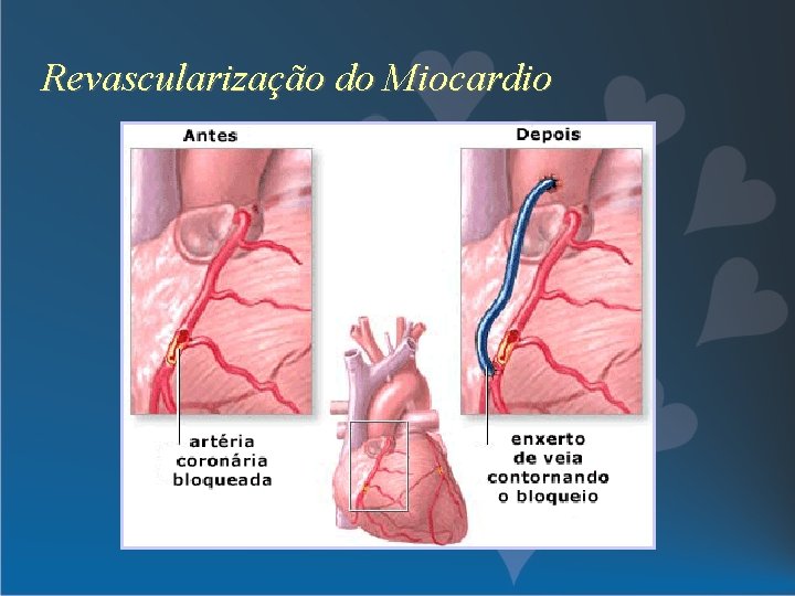 Revascularização do Miocardio 