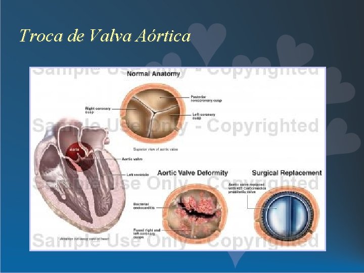 Troca de Valva Aórtica 