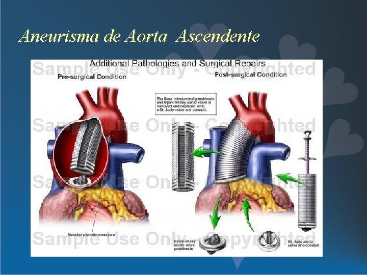 Aneurisma de Aorta Ascendente 