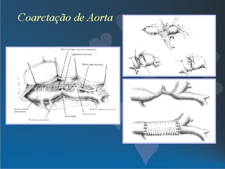 Coarctação de Aorta 