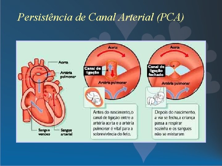 Persistência de Canal Arterial (PCA) 