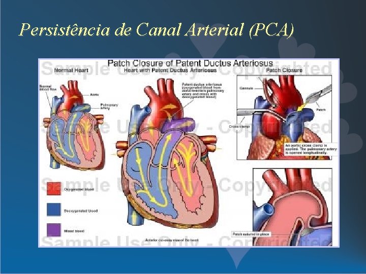 Persistência de Canal Arterial (PCA) 
