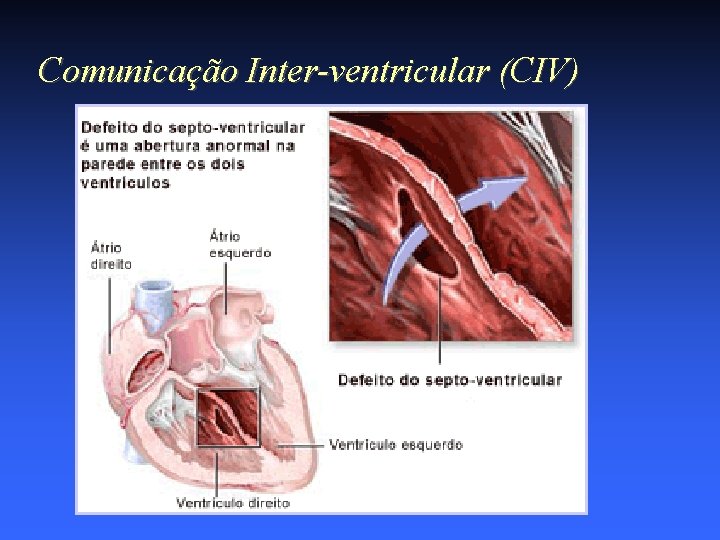 Comunicação Inter-ventricular (CIV) 
