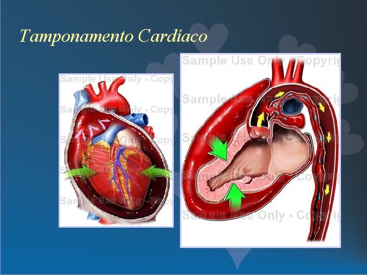 Tamponamento Cardíaco 