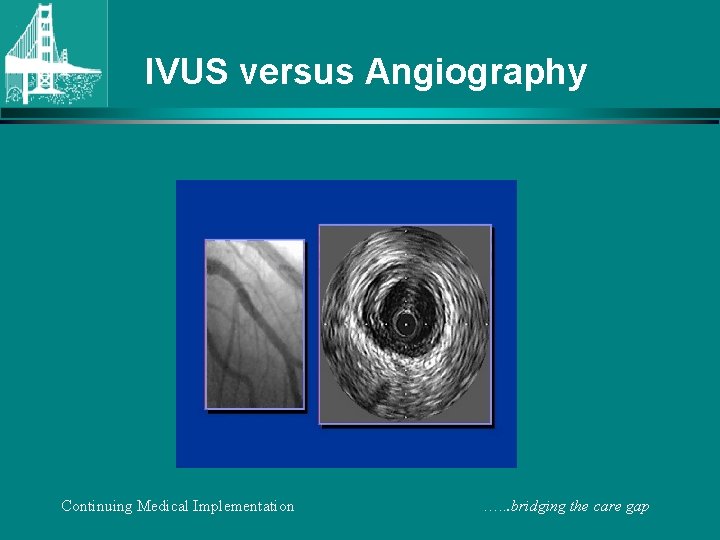 IVUS versus Angiography Continuing Medical Implementation …. . . bridging the care gap 