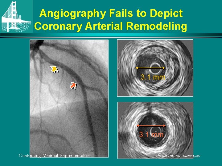 Angiography Fails to Depict Coronary Arterial Remodeling 3. 1 mm Continuing Medical Implementation ….