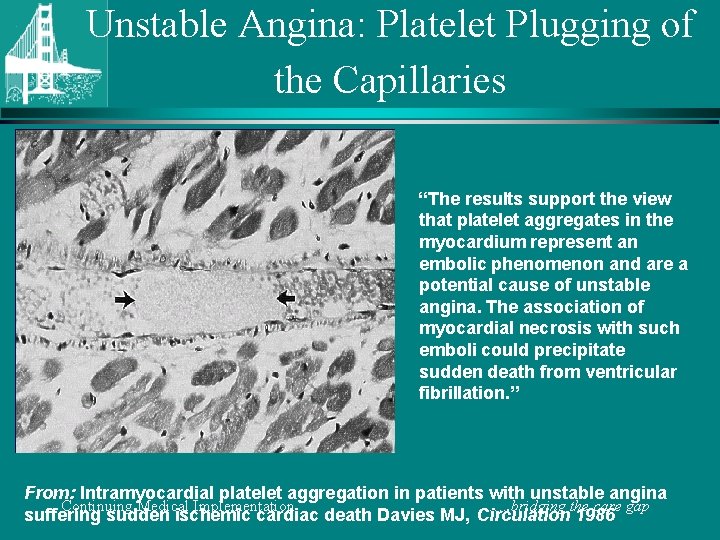 Unstable Angina: Platelet Plugging of the Capillaries “The results support the view that platelet