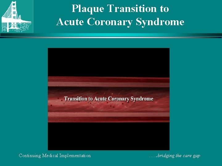 Plaque Transition to Acute Coronary Syndrome Continuing Medical Implementation …. . . bridging the