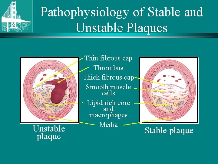 Pathophysiology of Stable and Unstable Plaques Unstable plaque Thin fibrous cap Thrombus Thick fibrous