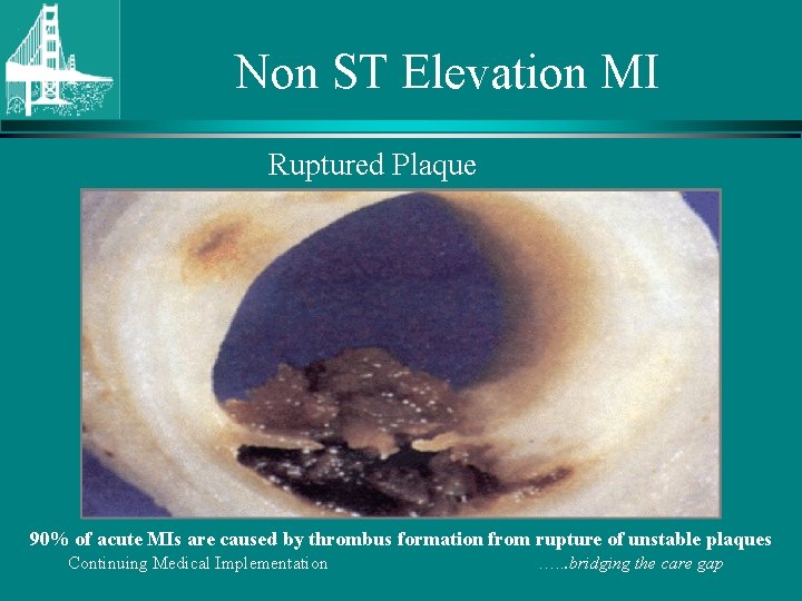 Non ST Elevation MI Ruptured Plaque 90% of acute MIs are caused by thrombus