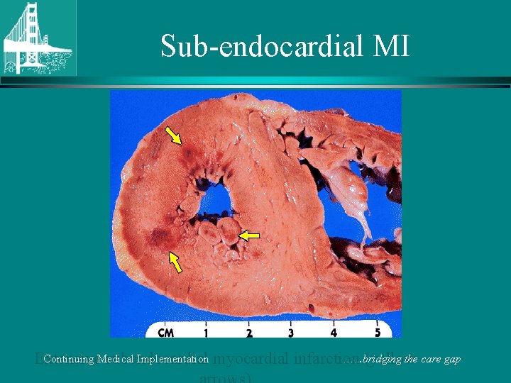 Sub-endocardial MI Continuing Medical Implementation …. . . bridging the care gap Extensive subendocardial