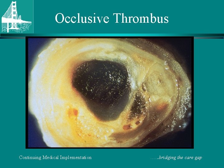 Occlusive Thrombus Continuing Medical Implementation …. . . bridging the care gap 