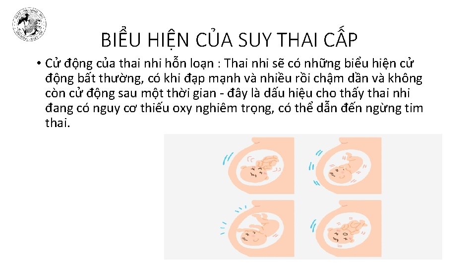 BIỂU HIỆN CỦA SUY THAI CẤP • Cử động của thai nhi hỗn loạn