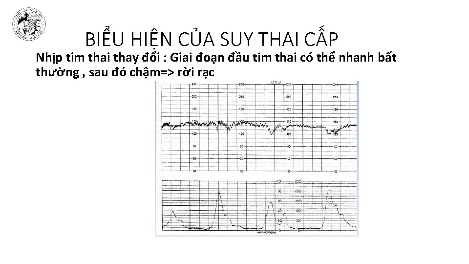 BIỂU HIỆN CỦA SUY THAI CẤP Nhịp tim thai thay đổi : Giai đoạn