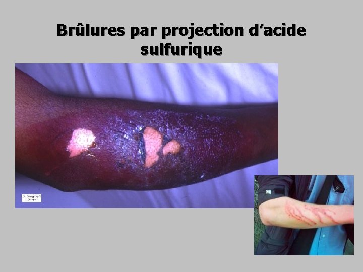 Brûlures par projection d’acide sulfurique 