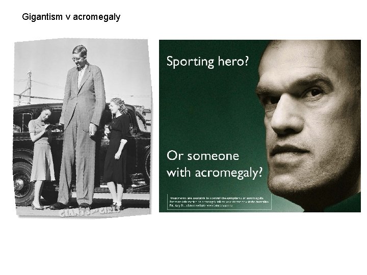 Gigantism v acromegaly Gigantism v acromegaly