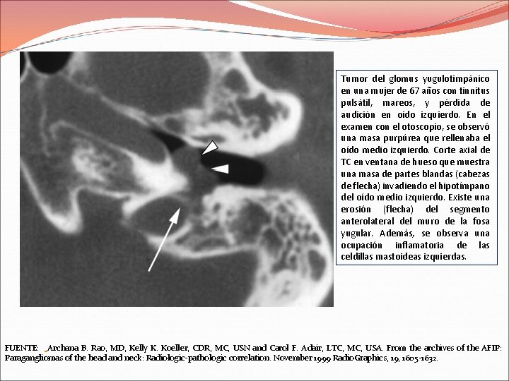 Tumor del glomus yugulotimpánico en una mujer de 67 años con tinnitus pulsátil, mareos,