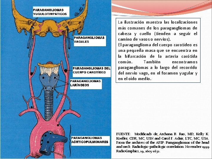 La ilustración muestra las localizaciones más comunes de los paragangliomas de cabeza y cuello